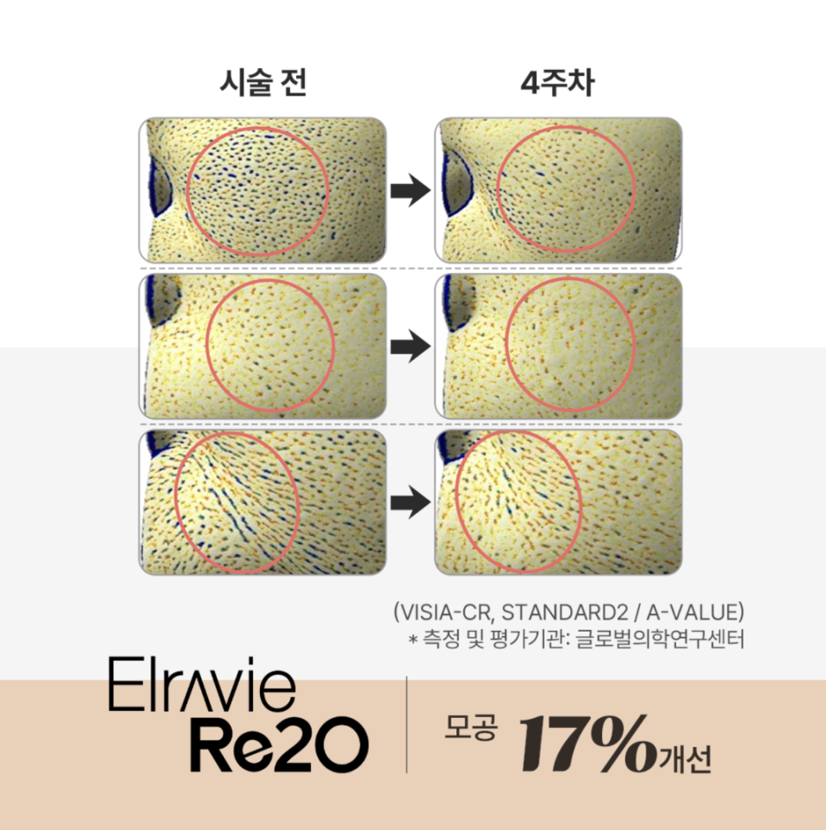 STEP1 노화로 빈 공간이 생긴 진피
